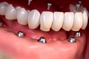 ایمپلت دندان در کوتاه‌ترین زمان به صورت اقساط