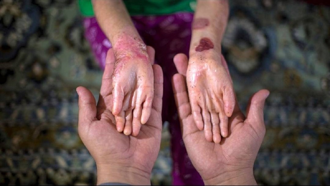 محموله نفتی آمریکا به نفع بیماران پروانه‌ای به فروش رسید+ جزئیات