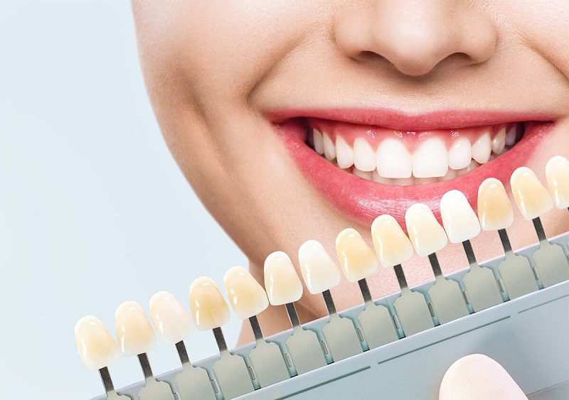تفاوت ارتودنسی با لمینت دندان