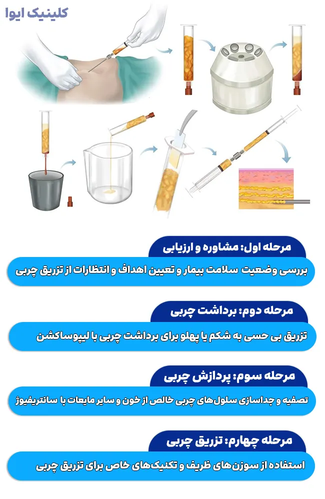 مراحل تزریق چربی