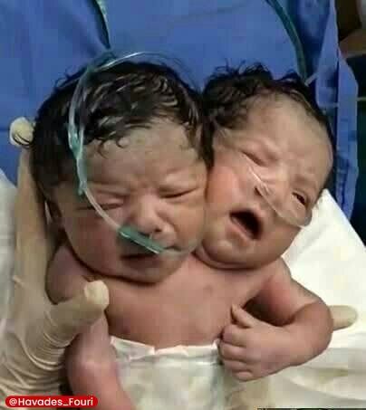 عکس | تولد نوزاد دو سر در مکزیک!