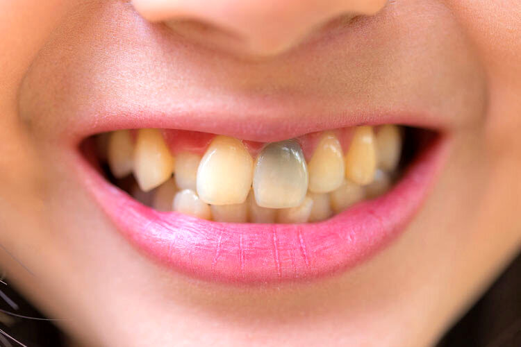 افشای رازهای مهم سلامتی شما با رنگ دندان هایتان / خطرناک ترین لکه چه رنگی است؟ 2