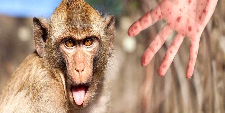 آبله میمون به ایران رسید؟