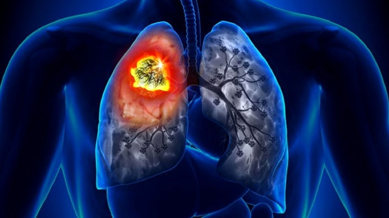 علائم رایج سرطان ریه را بشناسید