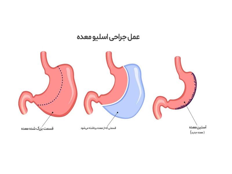 هر آنچه که باید درباره عمل اسلیو معده بدانید!