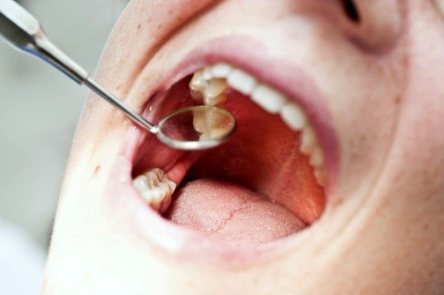 پوسیدگی دندان این بلا را سر بقیه اعضای بدن می‌آورد
