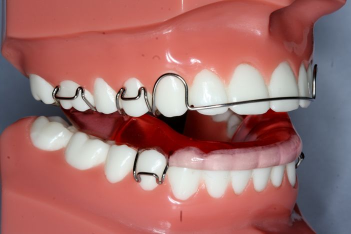 ارتودنسی فانکشنال:از بین بردن فشار روی دندانها و تغییرموقعیت فک