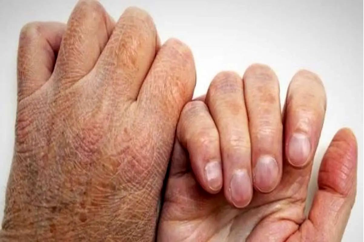 واکنش‌ها به شیوع بیماری جذام/ مقامات وزارت بهداشت تکذیب کردند