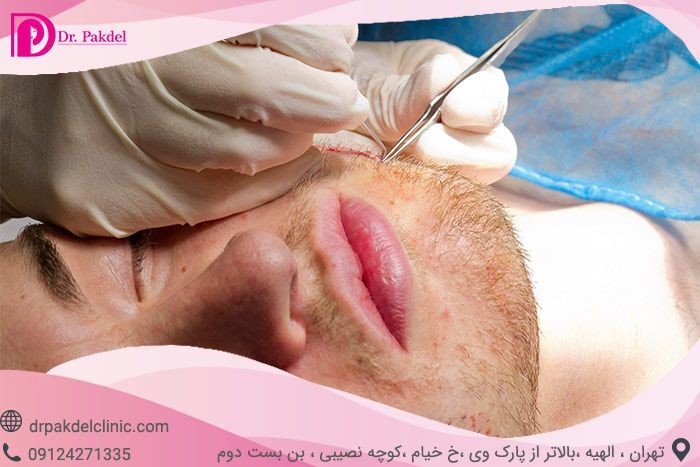 کاشت ریش چگونه انجام می شود؟ فیلم, قیمت, عوارض