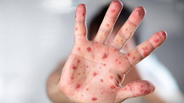 آبله میمونی چگونه منتقل می شود؟