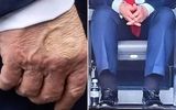 ترامپ به بیماری نارسایی مزمن وریدی مبتلا است