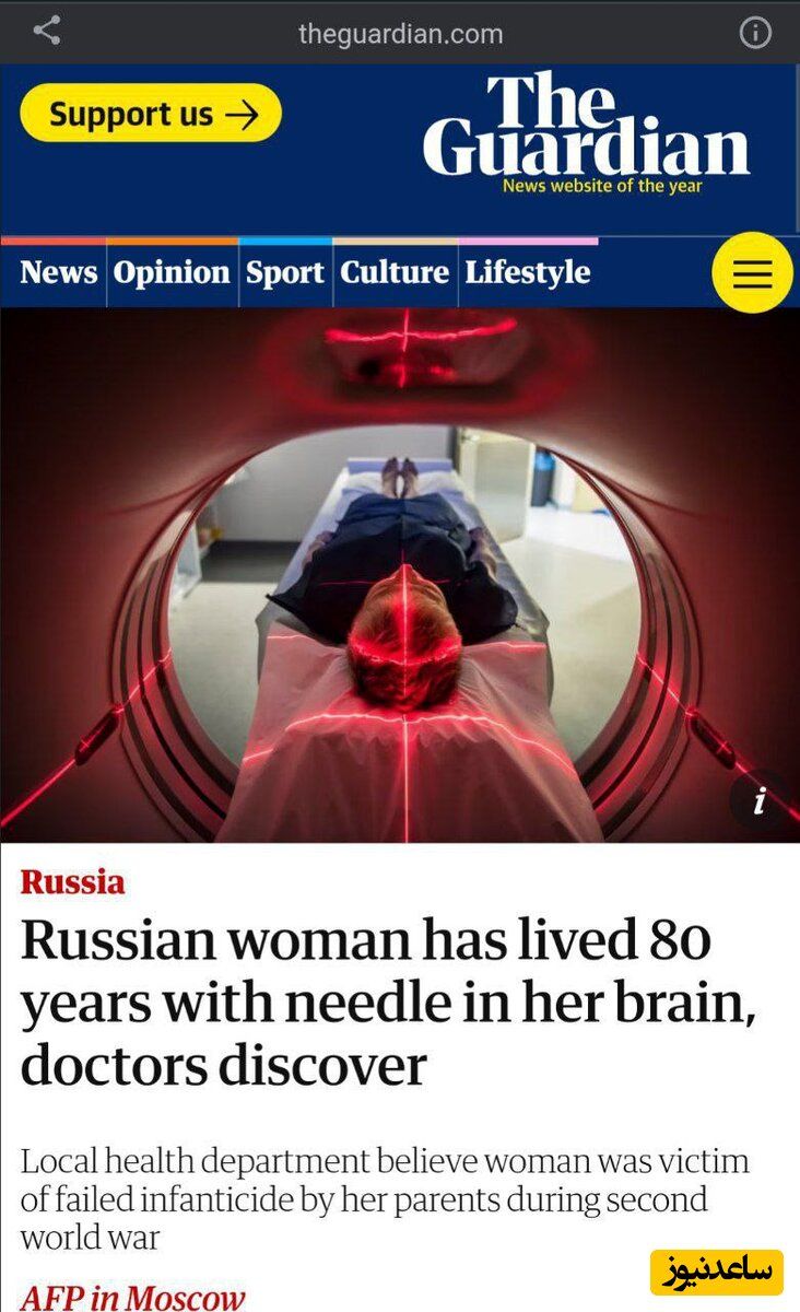 کشف یک سوزن مزاحم در مغز زن 80 ساله!
