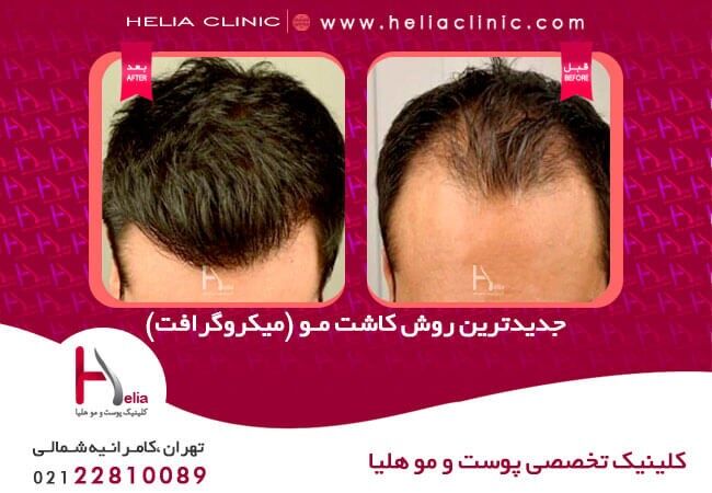 کاشت مو و ابرو با روش انحصاری میکروگرافت در کلینیک هلیا