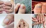 ۷ علامت هشداردهنده کلسترول بالا در ناخن/ این تغییر در ناخن ها خطرناک است