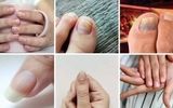 ۷ علامت هشداردهنده کلسترول بالا در ناخن/ این تغییر در ناخن ها خطرناک است