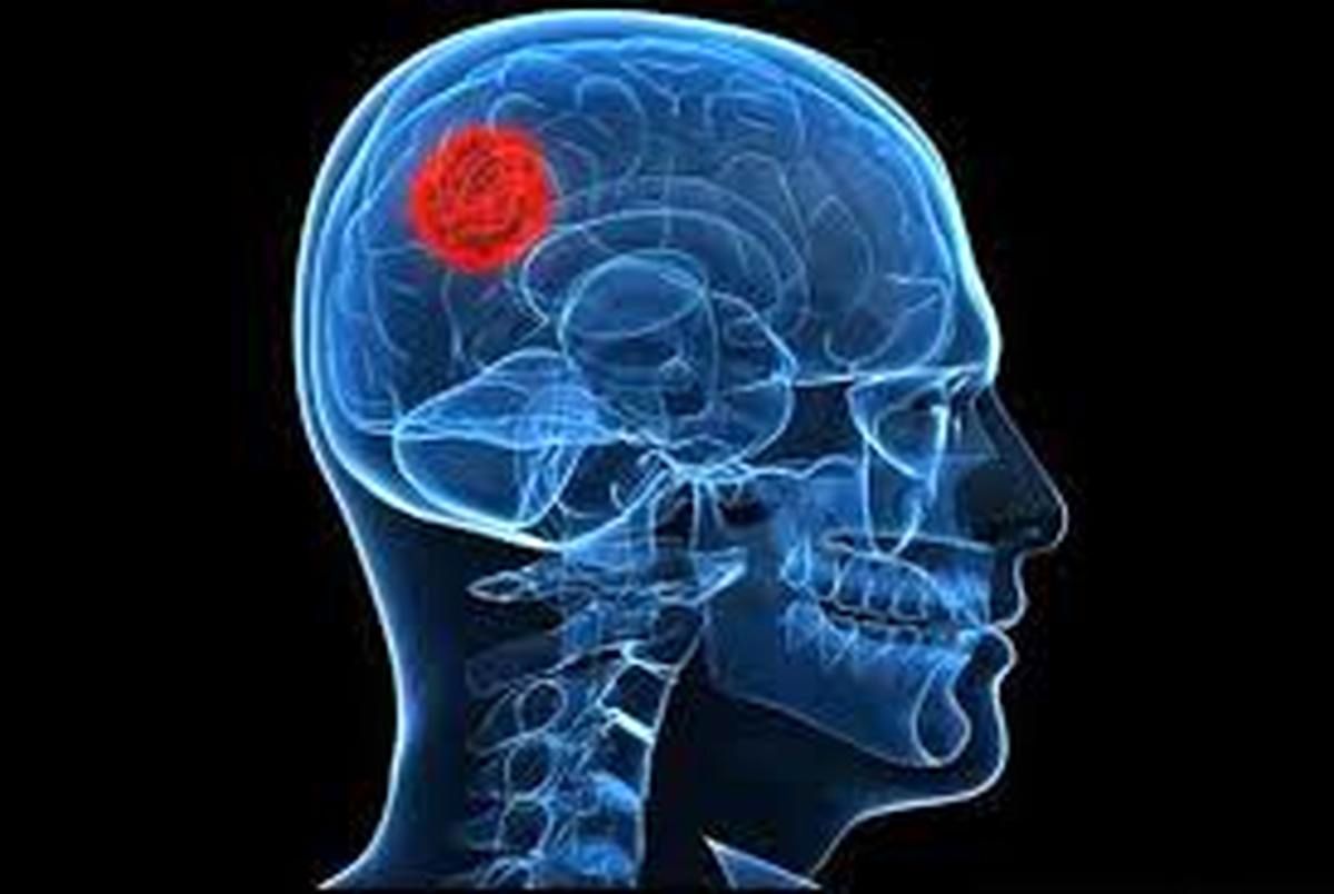 6 علامت «هشداردهنده» تومور مغزی 