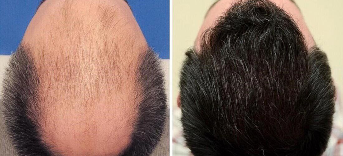 راهکارهایی برای پیشگیری از ریزش مجدد پس از کاشت مو
