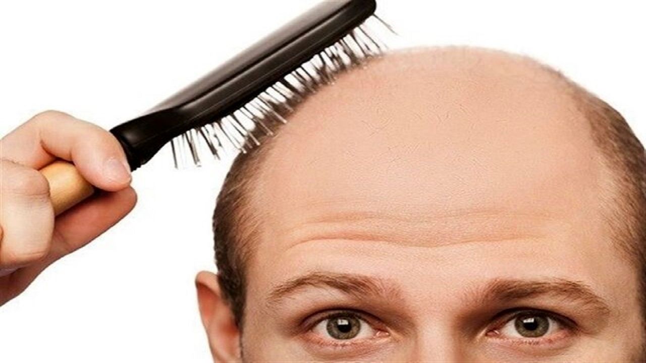 کمبود این ماده مهم در بدن، عامل ریزش مو است