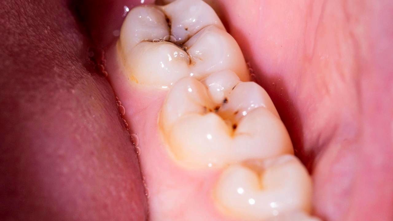 پوسیدگی دندان شایع‌ترین مشکل جوانان ایران و تبدیل شدن آن به پر هزینه‌ترین درمان‌های حوزه سلامت