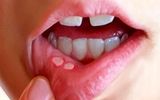 زخم‌های دردناک دهان چگونه ایجاد می شوند؟