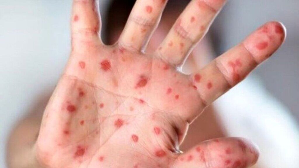 این کودکان باید علیه سرخک واکسینه شوند