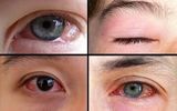 دلایل بروز و نشانه‌های حساسیت چشم در فصل پاییز