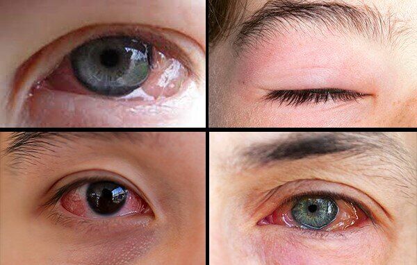 دلایل بروز و نشانه‌های حساسیت چشم در فصل پاییز