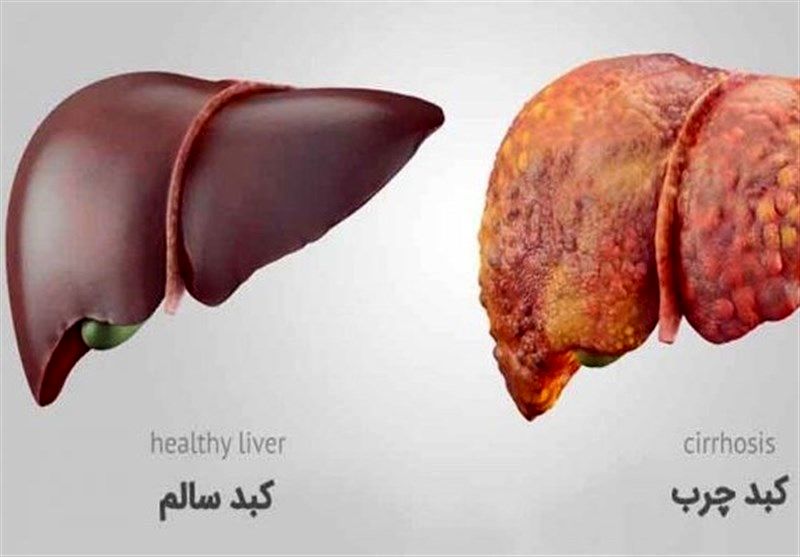 این ماده غذایی قاتل فوری کبد چرب است