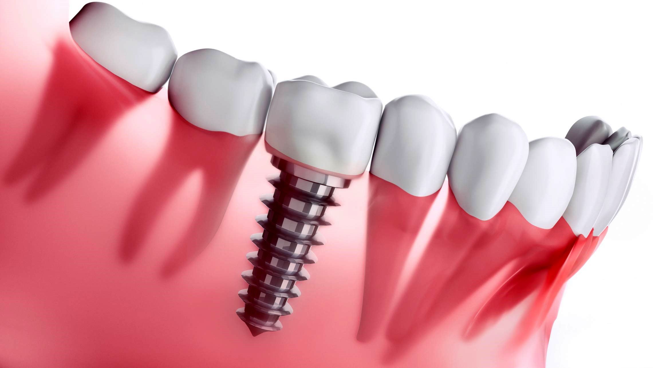  هزینه ایمپلنت دندان چقدر است؟