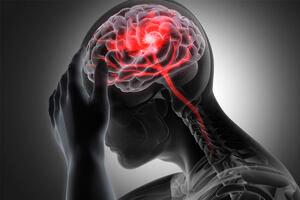 زنان بیشتر دچار سکته مغزی می شوند یا مردان؟/ زمان طلایی درمان را بشناسید