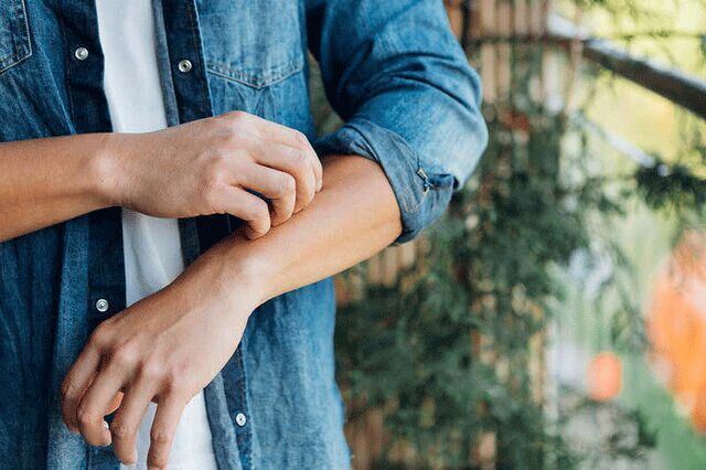 ۸ راه ساده برای از بین بردن خارش جای نیش پشه 