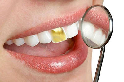 کمبود شدید دندانپزشک و رواج «دندان طلا»
