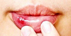 درمان‌های خانگی آفت دهان