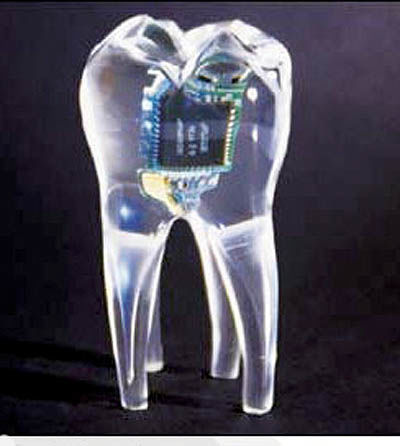 جاسازی تلفن‌همراه در دندان‌های آسیاب