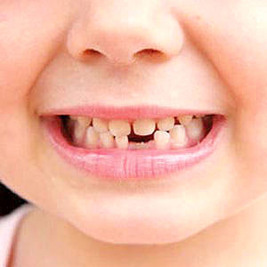 آبسه دندان شیری ناشی از پوسیدگی است