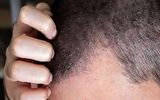 علائم اگزمای پوست سر را بشناسید/ اگزما با شوره سر چه تفاوتی دارد؟