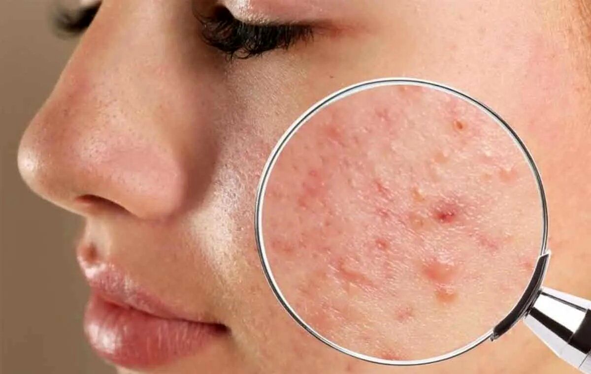 این روش های خانگی، قاتل جوش های چرکی و دردناک / علت به وجود آمدن جوشهای سر سفید چیست؟