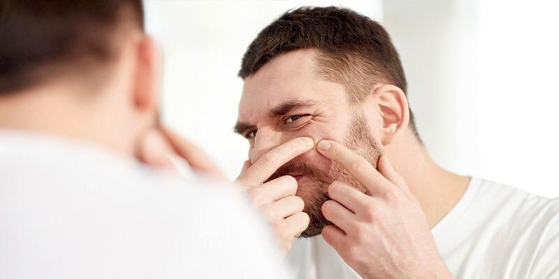این روش های خانگی، قاتل جوش های چرکی و دردناک / علت به وجود آمدن جوشهای سر سفید چیست؟ 5