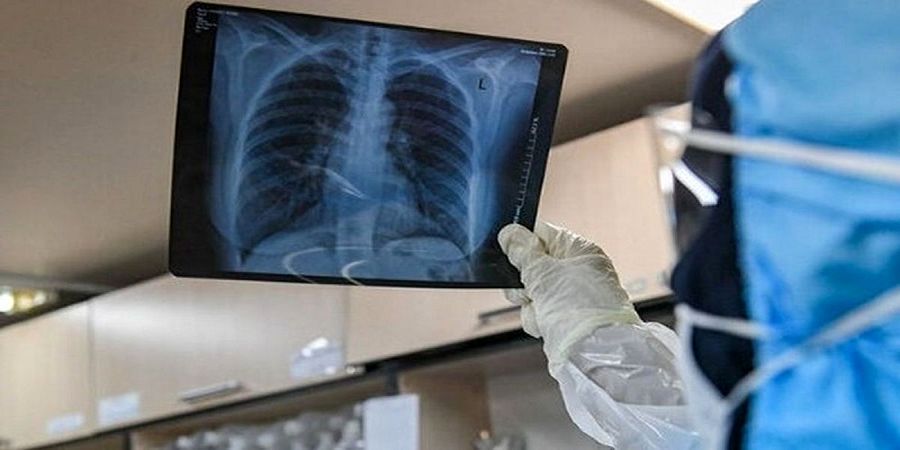 علائم درگیری ریه در کرونا را بشناسید