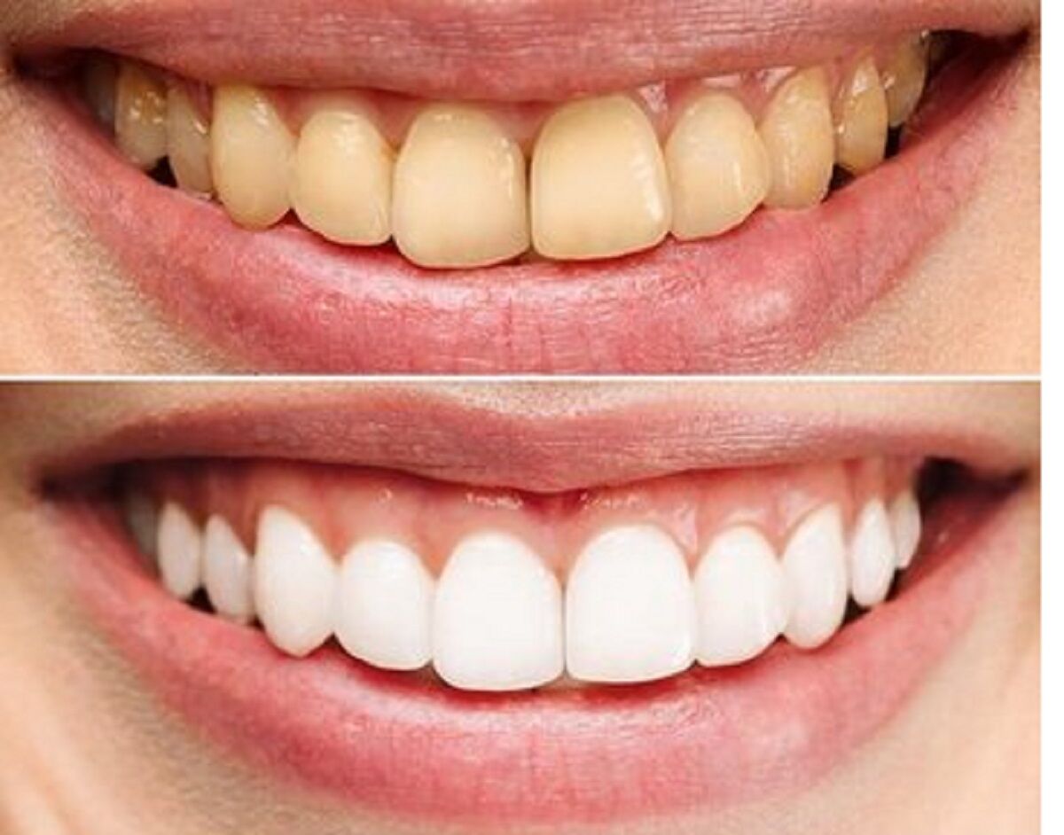 روزی چند بار مسواک بزنیم؟