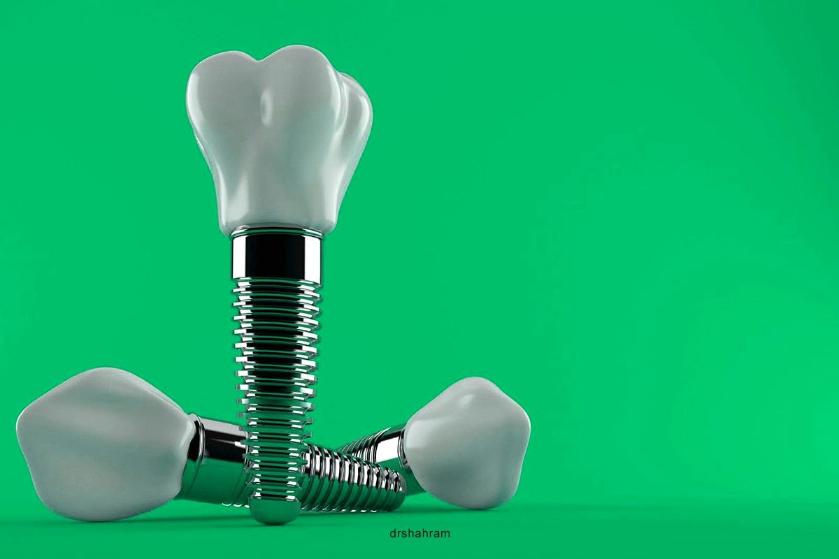 عوامل موثر بر قیمت ایمپلنت دندان + معرفی انواع ایمپلنت