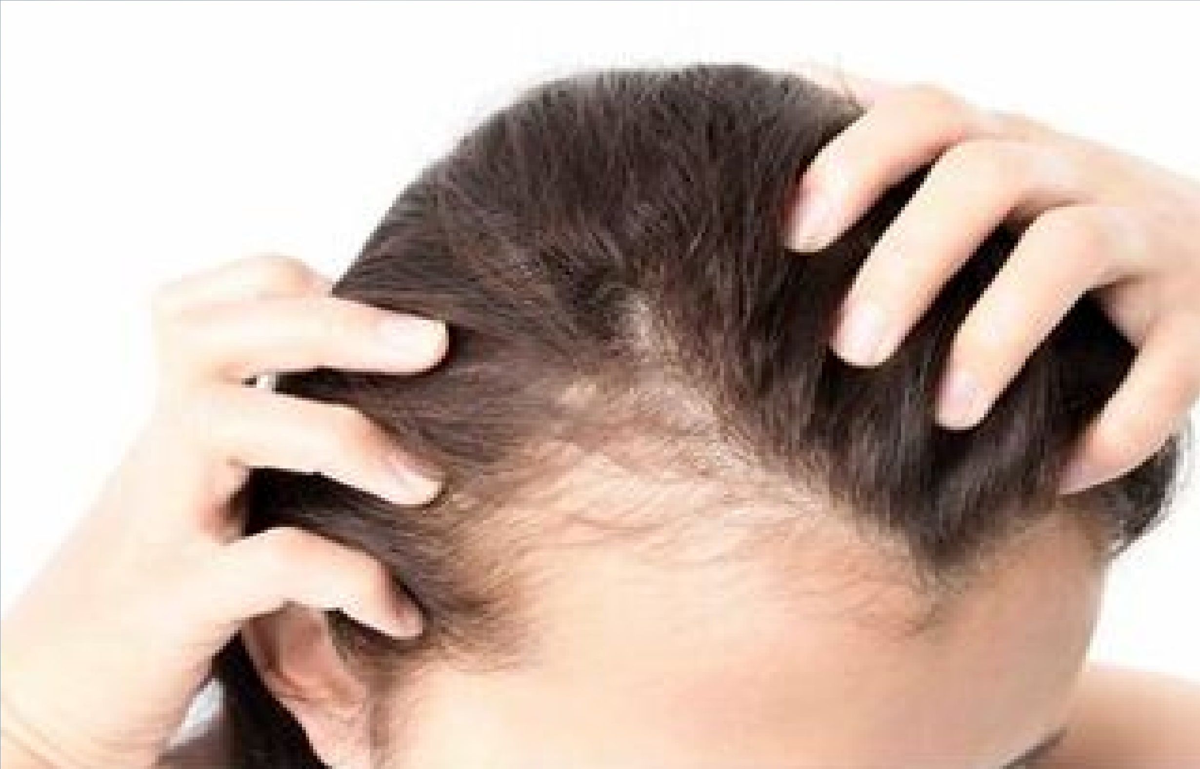 4 نکته کلیدی برای کسانی که از ریزش مو رنج می‌برند