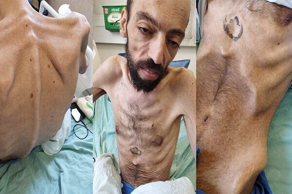 اسیر فلسطینی بعد از 170 روز اعتصاب غذای خود را شکست