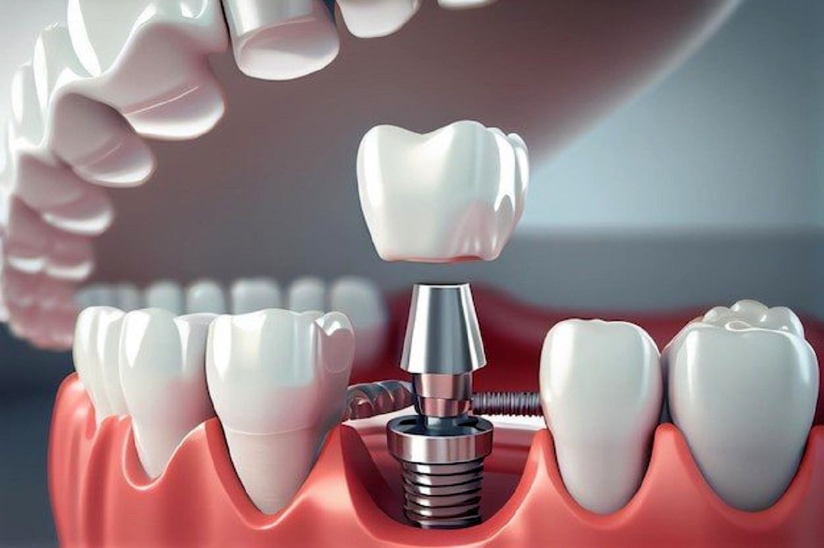 ایمپلنت فوری دندان در یک روز چیست؟ + مزایا، معایب و مراحل