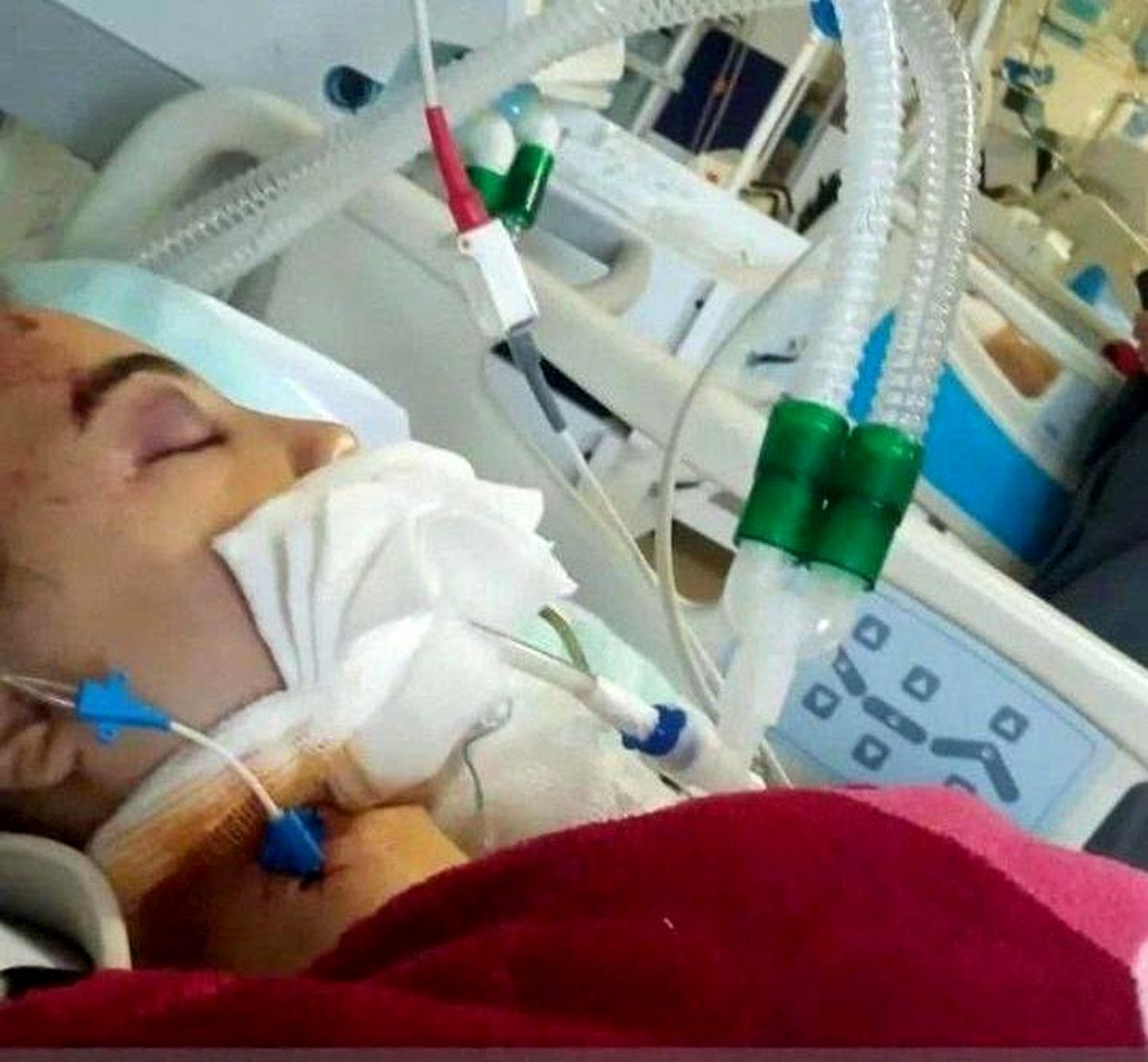 حقیقت نزد دختری است که در کما بود /«هستی حسینپناهی» دختر 16 سالهای که آبان 1401 خود را از سرویس مدرسه بیرون پرتاب کرد