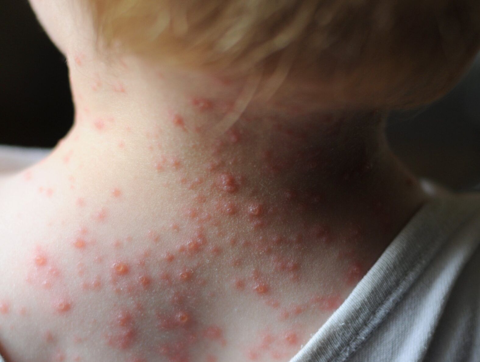 علائم ابتدا به آبله مرغان در بزرگسالی/ عوارض خطرناک ابتلا به این ویروس چیست؟