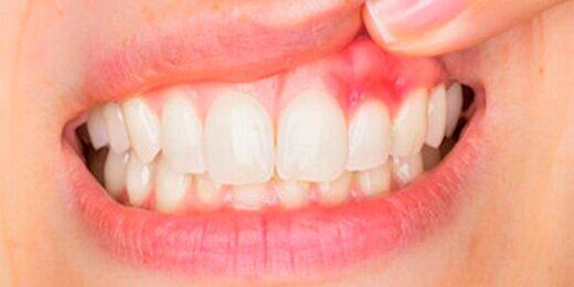 اگر لثه‌هایتان ورم می‌کند و التهاب دارد، این توصیه ها را بخوانید