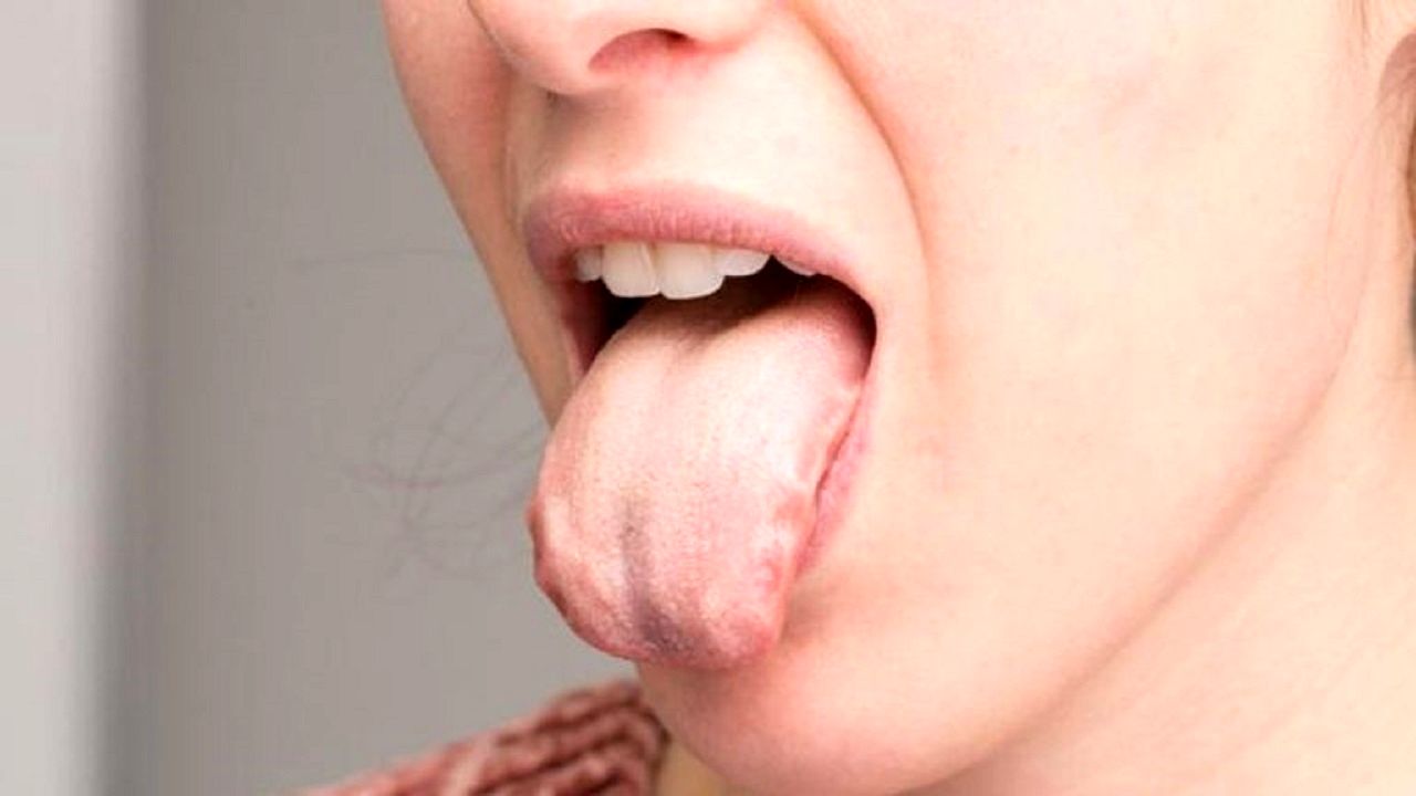 هشدار جدی درباره بیماری‌هایی با علامت سوزش زبان
