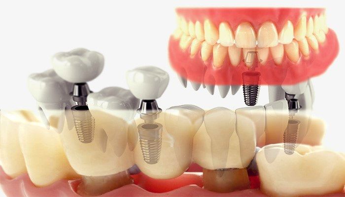 ایمپلنت دندان یا دندان مصنوعی؟ سوال این است