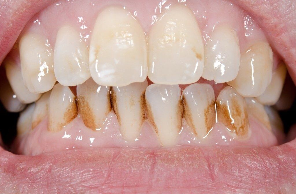 افشای رازهای مهم سلامتی شما با رنگ دندان هایتان / خطرناک ترین لکه چه رنگی است؟ 3